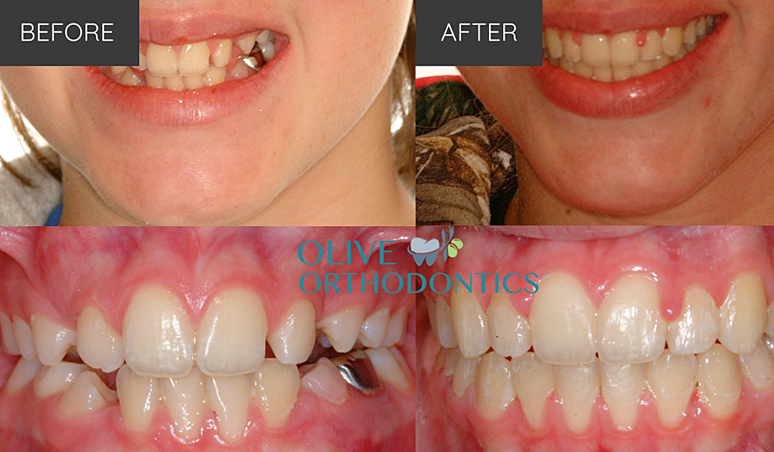 orthodontist before after photos St Louis MO