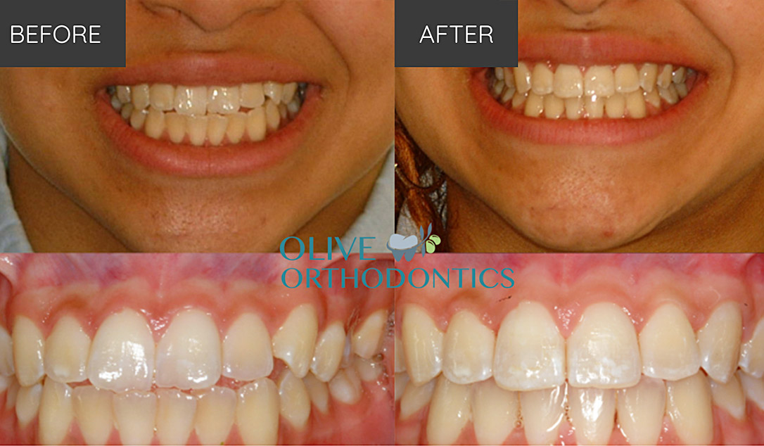 orthodontist before after photos St Louis MO