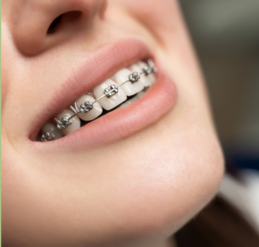 Close Up Of Orthodontic Patient Wearing Braces in St. Louis, MO