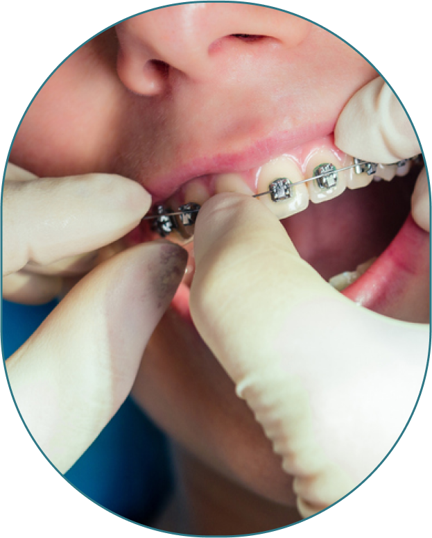 Close Up Of Orthodontist Adjusting Braces In Patients Mouth