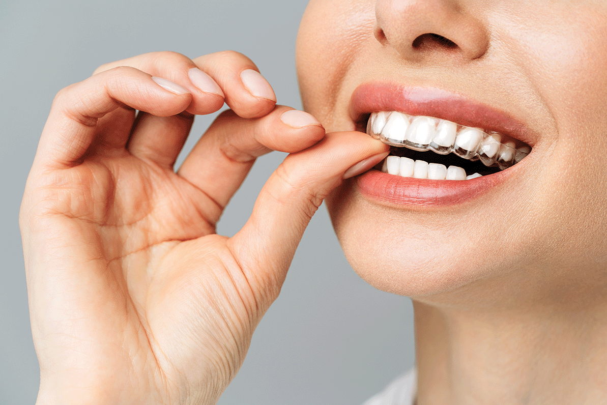 Close Up Of Smiling Woman Placing Invisible Retainer In Mouth
