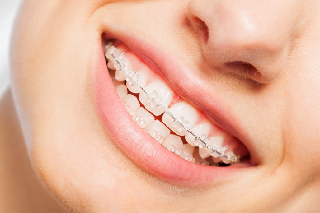 close up of woman wearing clear braces