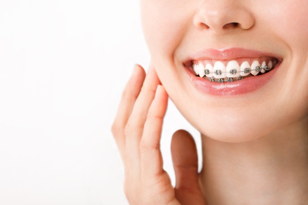 close up of woman wearing metal braces