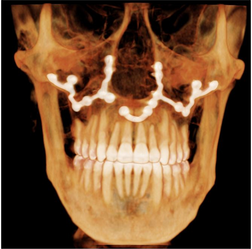 Xray Of Teeth