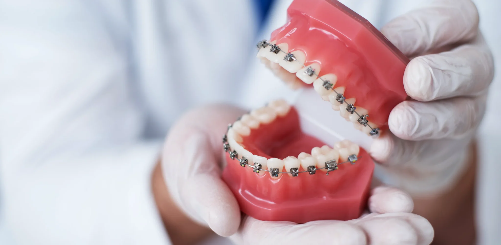Doctor holding braces sample